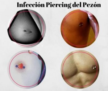 Piercing Del Pezón Infectado